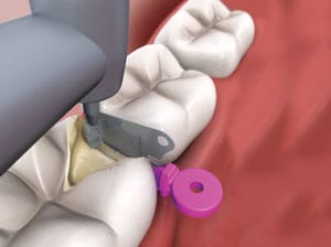wedgeguard2