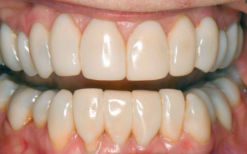 BioClear Matrix 2 - Super Dent Distribution Bioclear - dupa