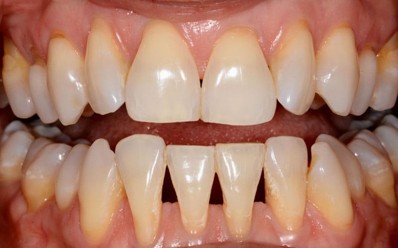 BioClear Matrix 1 - Super Dent Distribution Bioclear - inainte